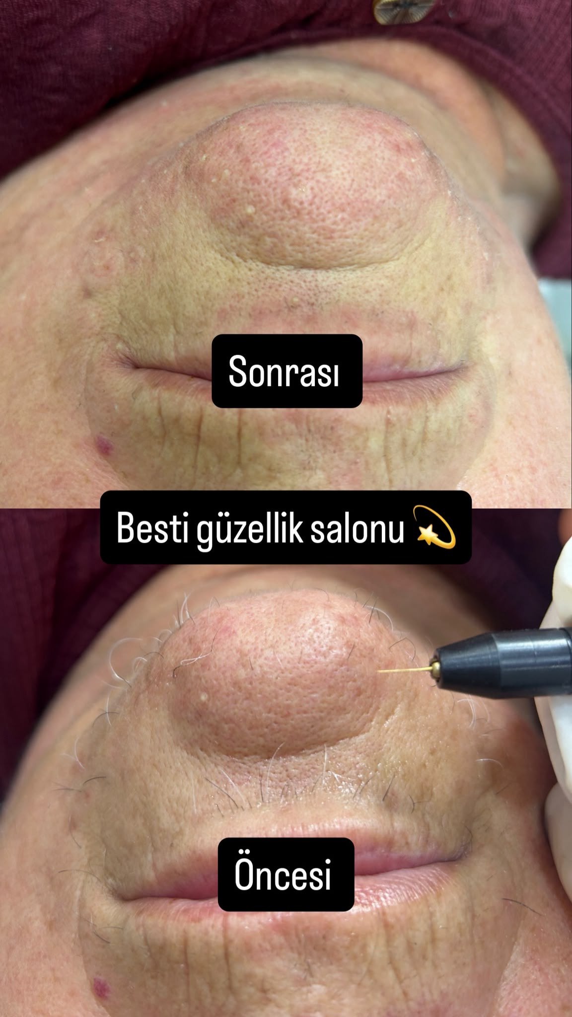 Cilt bakımı öncesi sonrası